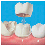 Dental Crowns